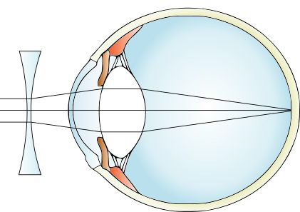 kontaktní čočky pro korekci krátkozrakosti
